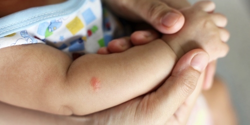 Penggunaan lotion bisa jadi cara menghilangkan bekas gigitan nyamuk pada bayi. Lalu, apa lagi cara alami untuk menghilangkan bekas gigitan nyamuk?