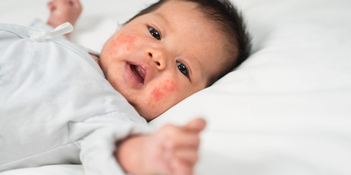 Cara menghilangkan bintik merah di wajah bayi bisa dengan menggunakan losion calamine atau menjemur di pagi hari. Apa lagi cara alaminya yang mudah?

