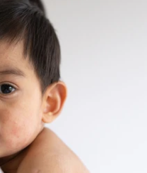 Campak pada bayi bisa berbahaya dan menyebabkan komplikasi serius. Ketahui penyebab, gejala dan cara mencegahnya di artikel ini, Bun.