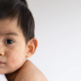 Kenali Penyebab, Gejala, dan Cara Mengatasi Campak pada Bayi