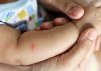 9 Cara Menghilangkan Bekas Gigitan Nyamuk pada Bayi