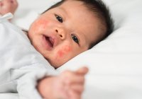 8 Cara Menghilangkan Bintik Merah di Wajah Bayi