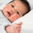 Cara menghilangkan bintik merah di wajah bayi-sgm